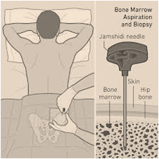Bone marrow donation for cancer treatment