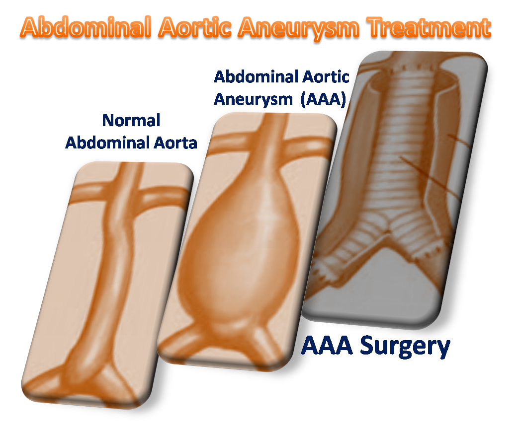 Abdominal Aortic Aneurysm can be fatal if left unattended 